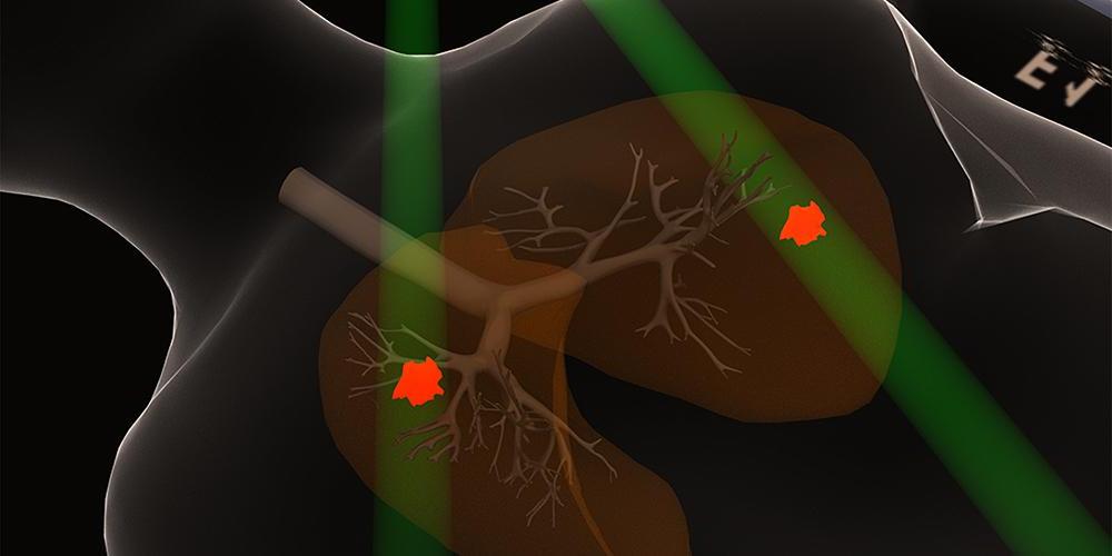 A scan of small-cell lung cancer